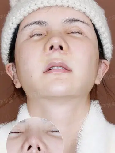 13年六次鼻整形案例分享,难度系数5颗星