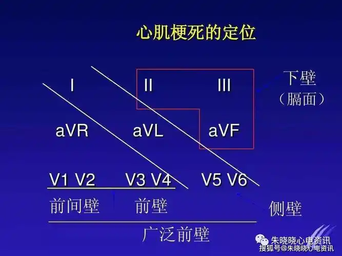 第十六讲:心肌梗死(三)_心电图