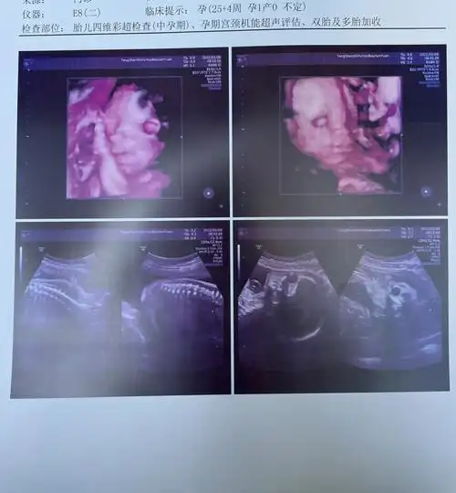 双胎产检四维心脏彩超顺利通过啦