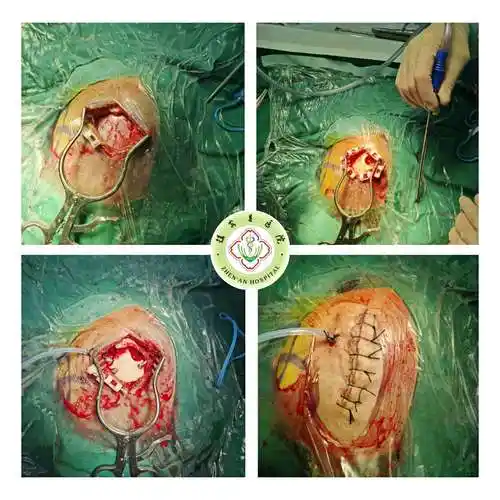 新技术开展——镇安县医院神经外科首例神经内镜下脑出血微创血肿清除