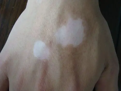 白癜风(局限型)