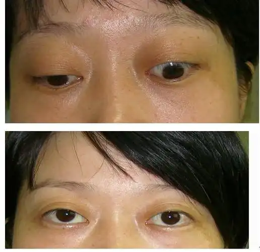 重症甲亢突眼怎么治疗?