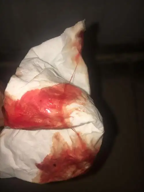  追问 来月经流出白带