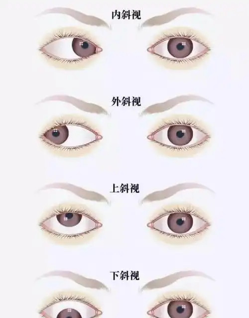 宝宝的眼肌还在发育,偶尔可能会出现对眼,尤其是宝宝累了的时候,比如