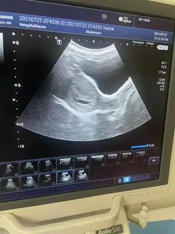 育儿问答 怀孕期 请问孕35天有孕囊,45天有胎芽暂无胎心,形态扁正常吗