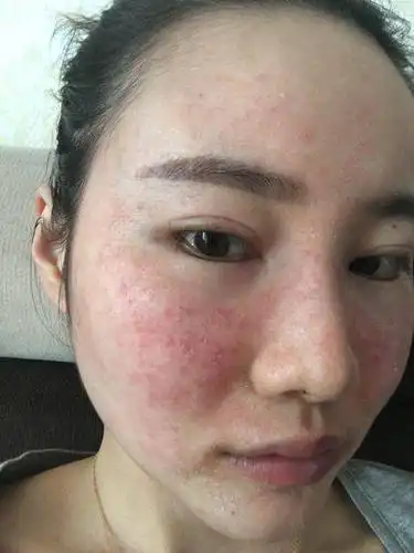 痘痘激素脸不能吃什么?