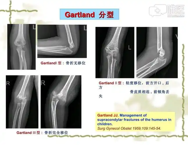 儿童肱骨髁上骨折(gartland~Ⅲb型骨折),真的不可以实现医生零射线,不