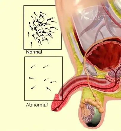 男性性兴奋时尿道流出白色透明状分泌物的到底是什么? - 好大夫在线
