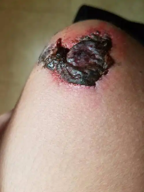 摔倒了结痂了 现在这样可以洗澡了吗 应该还有多久就会好