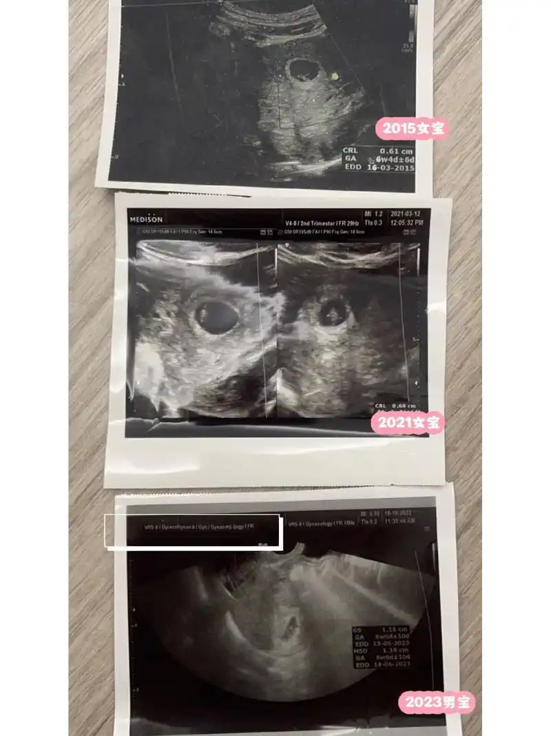 孕囊形状分辨男女宝准吗?