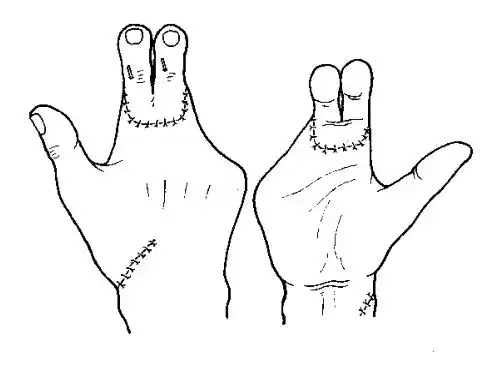 断指再植_治疗介绍_费用 - 好大夫在线