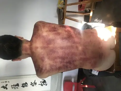 顽固性口腔溃疡刮痧记 - 简书