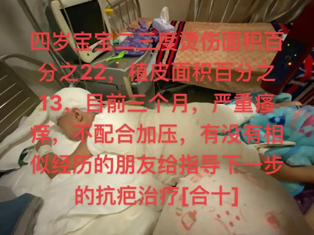 四岁宝宝二三度烫伤面积百分之22,植皮面积百分之13,目前三 - 抖音