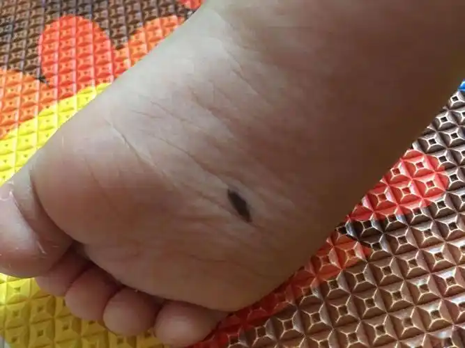 关于痣,妈妈要知道这些……_图片