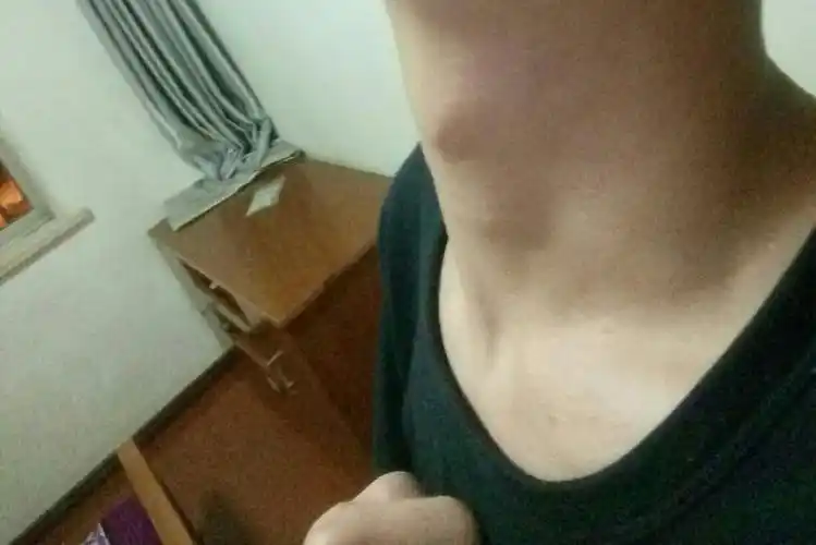 我14岁 1米73 喉结突出1厘米了 喉结硬硬的 脸上还有痘痘我还能长高吗