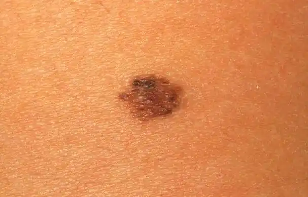 痣人人都有,但这4种痣最好去点掉,尤其是长在私处的痣