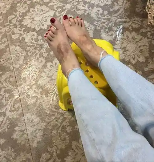 四川24岁烧伤女孩描述车祸细节关键时刻她无法打开车门