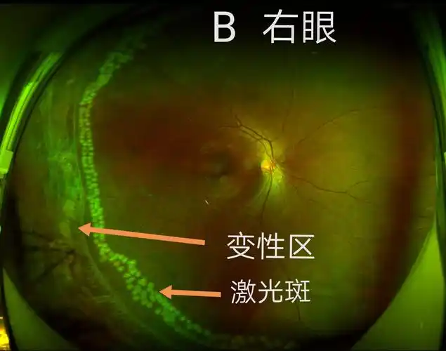 详述:家族性渗出性玻璃体视网膜病变(fevr)治疗方法,遗传方式.