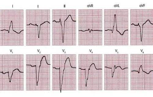 临床实用心电图入门第三十三讲室内传导阻滞(2)