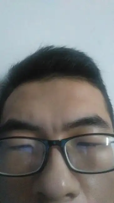 请大家帮我看看,我这是怎么了,印堂凹陷还是怎么样了,该怎么办,谢谢