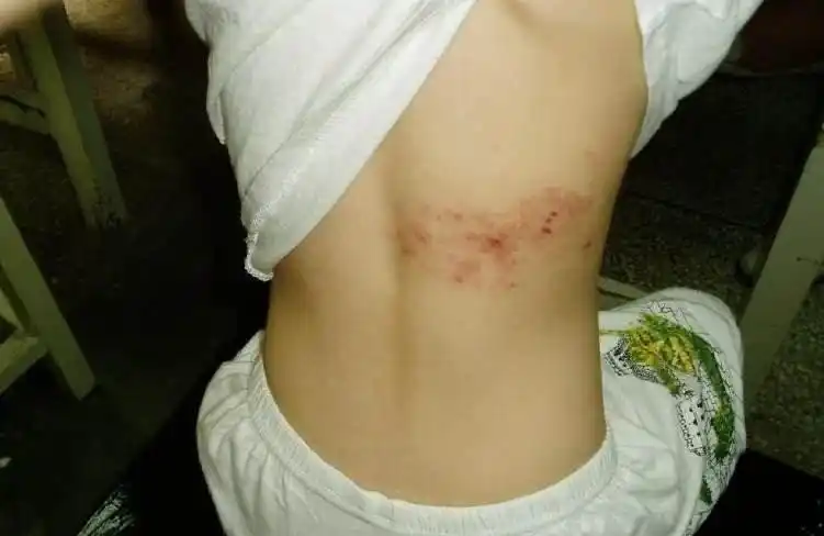 得了缠腰龙一块白矾就能解决何必那么麻烦