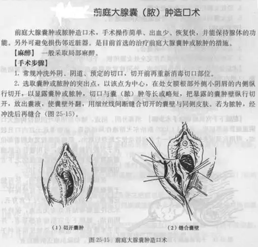 前庭大腺平时是处于"沉睡"状态的,并不分泌黏液,只有在女性性兴繁时
