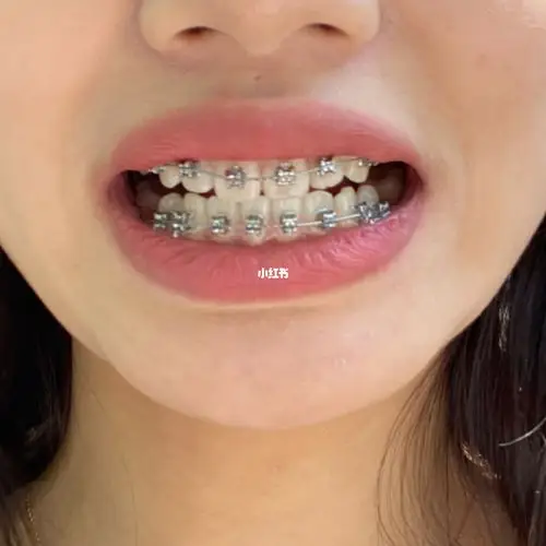 整牙日记#终于带上牙套啦_整牙_牙套_日记_陶瓷_隐适美怎么样_拔牙_美