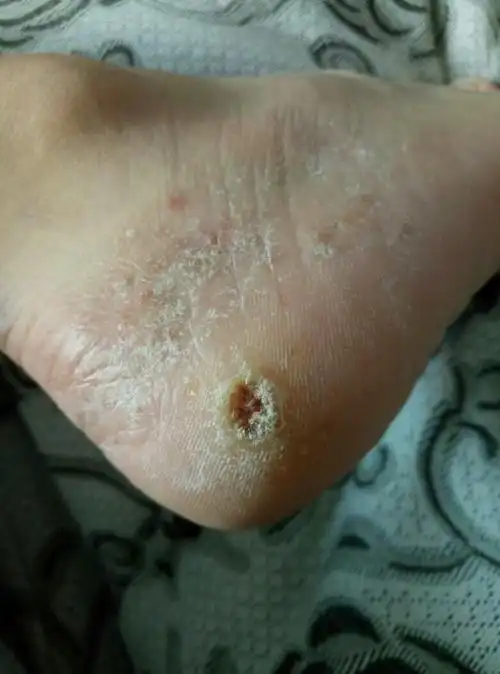 脚底有四五个洞 洞里有黑色的东西 脚后跟也有 长了很久了 不疼但很