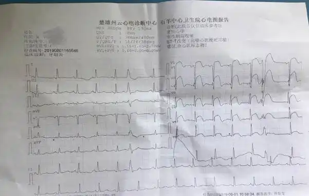 (抵达卫生院后首份心电图16:58)18:12,救护车绕行急诊科,直达心内科