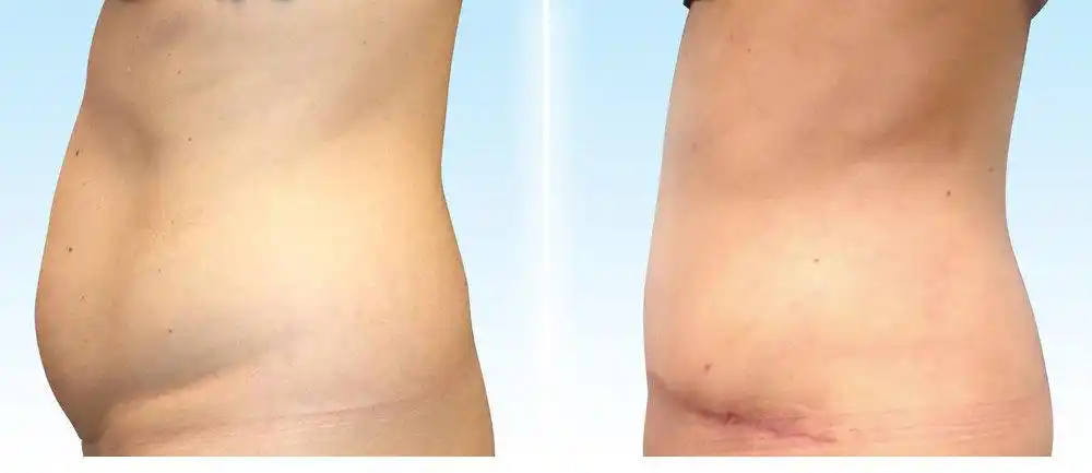 腹部拉皮/腹壁成形,能减肥吗?和腰腹环吸,袖状胃切除的区别?