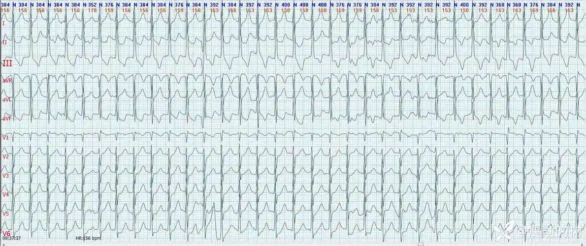 心电图病例 - 丁香园论坛
