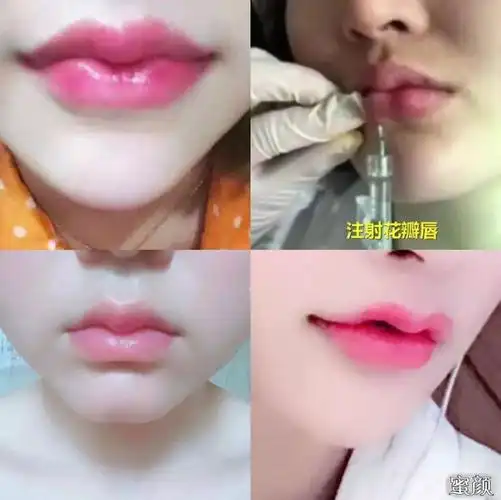 类似花瓣唇,嘟嘟唇,微笑唇等都是玻尿酸丰唇的形式的称呼,它采用