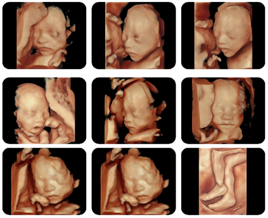 四维查出胎儿唇裂,为所有孕妈敲响警钟!