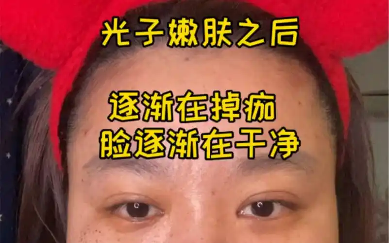 光子嫩肤day6 痂掉的比较慢_哔哩哔哩 (゜-゜)つロ 干杯~-bilibili