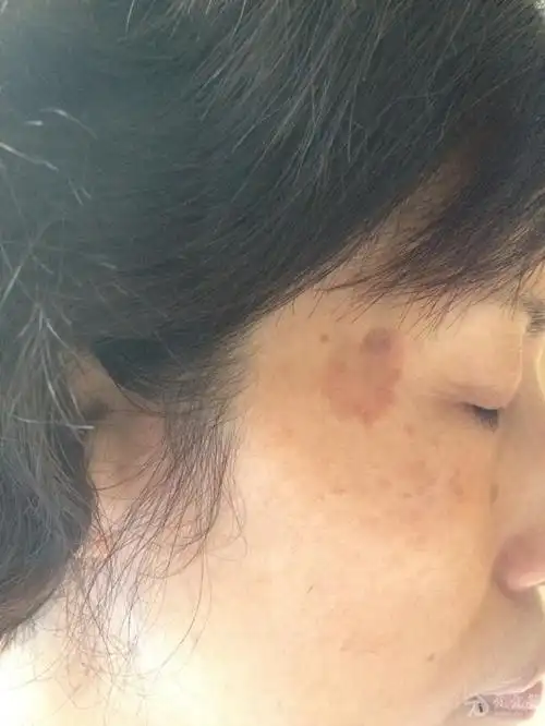 面部褐色斑10余年,痒1月