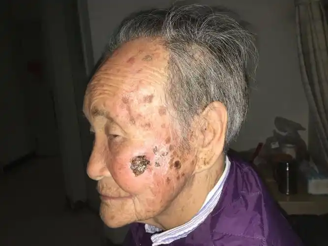 面部基底细胞癌 - 好大夫在线