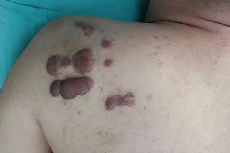 瘢痕疙瘩怎么治疗