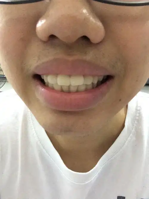 (照片)牙齿前突,想纠正,门牙大,牙缝小,请问怎么办?