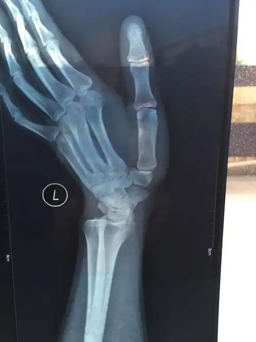 左手手腕舟骨骨折,这受伤程度严重吗?目前已夹板固定敷药8天.