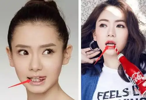 前后交错的下牙笑起来很影响颜值牙齿矫正做微调所以这个美妞们要慎重