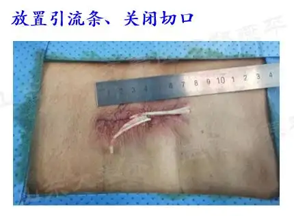 操作流程(附图):(13)关闭切口,放置引流条.(12)再次透视确认螺钉位置.
