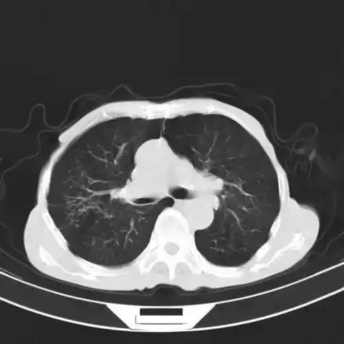正常肺ct影像图解(12个病人的肺ct图像详细解读)(12)