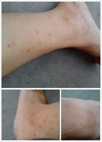 预防宝宝被虫咬皮炎图片