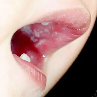 马牙与鹅口疮的鉴别与护理办法