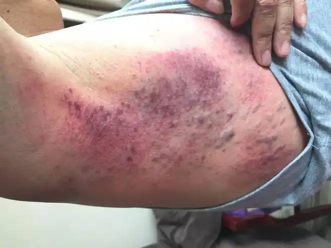 紫红色:瘀热,容易酸痛;红色:风热,多见于亚健康;潮红色:正常;用痧自我