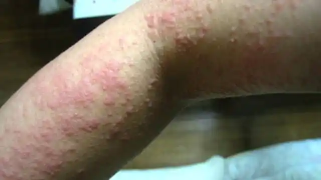 不得不说:皮肤上有2种"痒",肝癌下达"最后通知",上点心