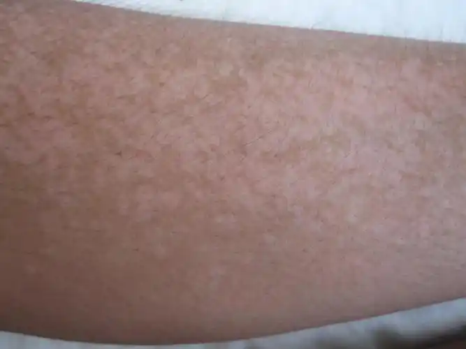 "白斑"不等于"白癜风"_张召力医生文章_厦门市第五医院-微医