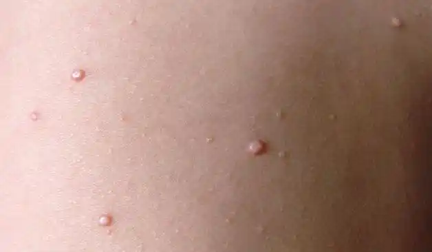 苹果绿 保健常识初期小疣体一般是在皮肤上出现凸起小丘疹,颜色呈现为