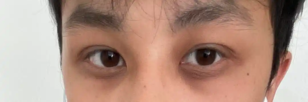 应该没几个人黑眼圈比我更重了吧?