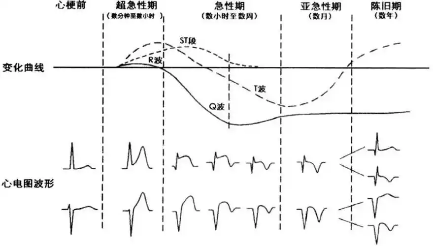心电图出现q波,本文解决你90%的难题!